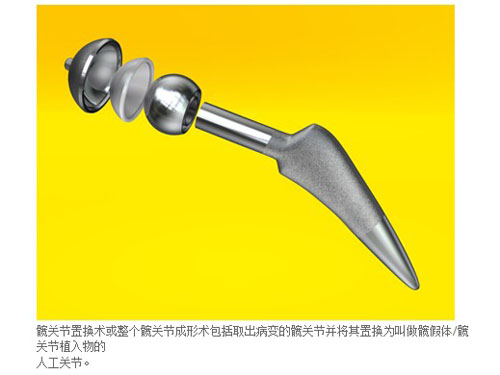 髖關節(jié)